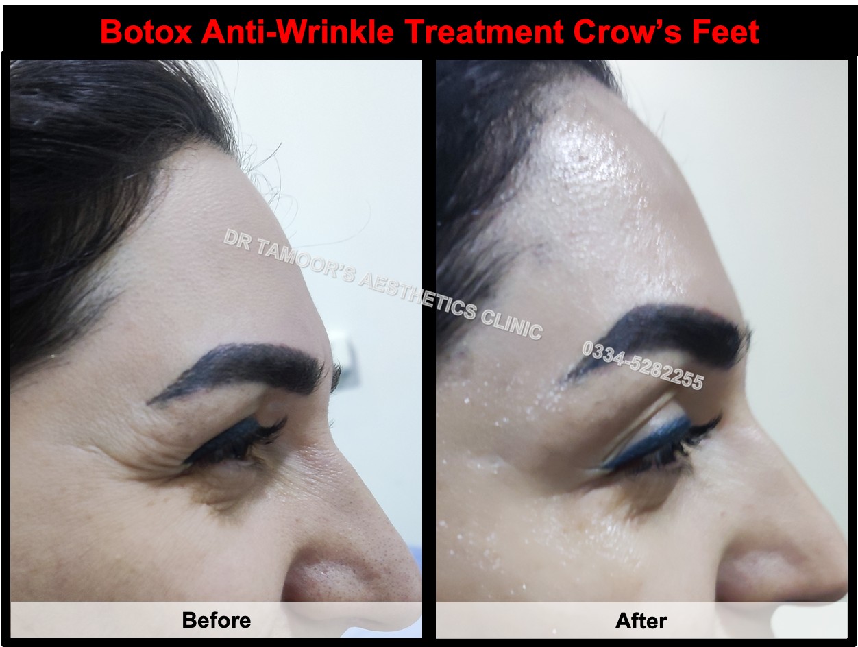 Before and after results of crows feet botox treatment in Islamabad