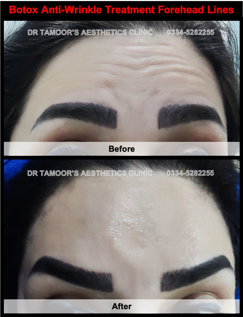 Before and after results of brow lift botox treatment in Islamabad