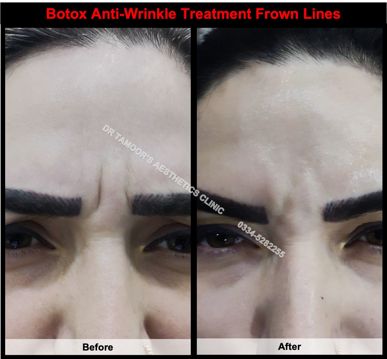 Before and after results of frown lines botox treatment in Islamabad