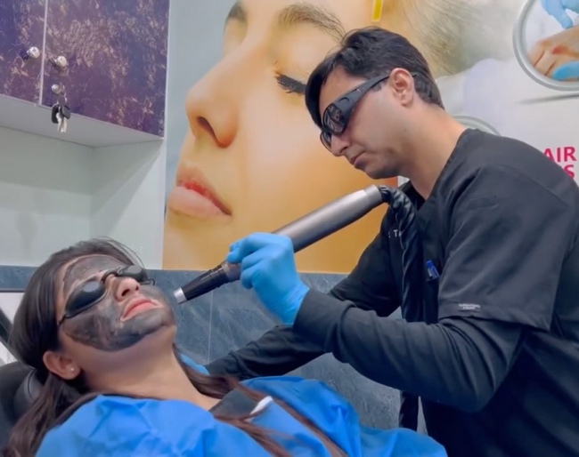 Carbon Laser Facial of a patient in Islamabad
