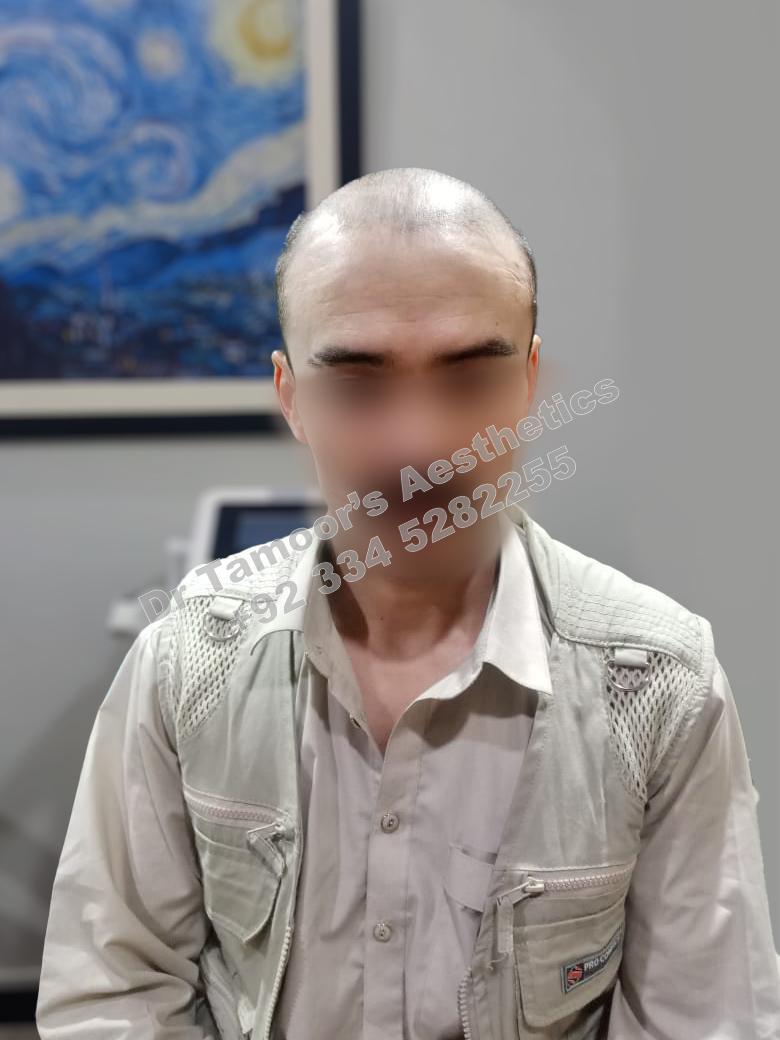 Before and after results of Hair Transplant procedure in Islamabad