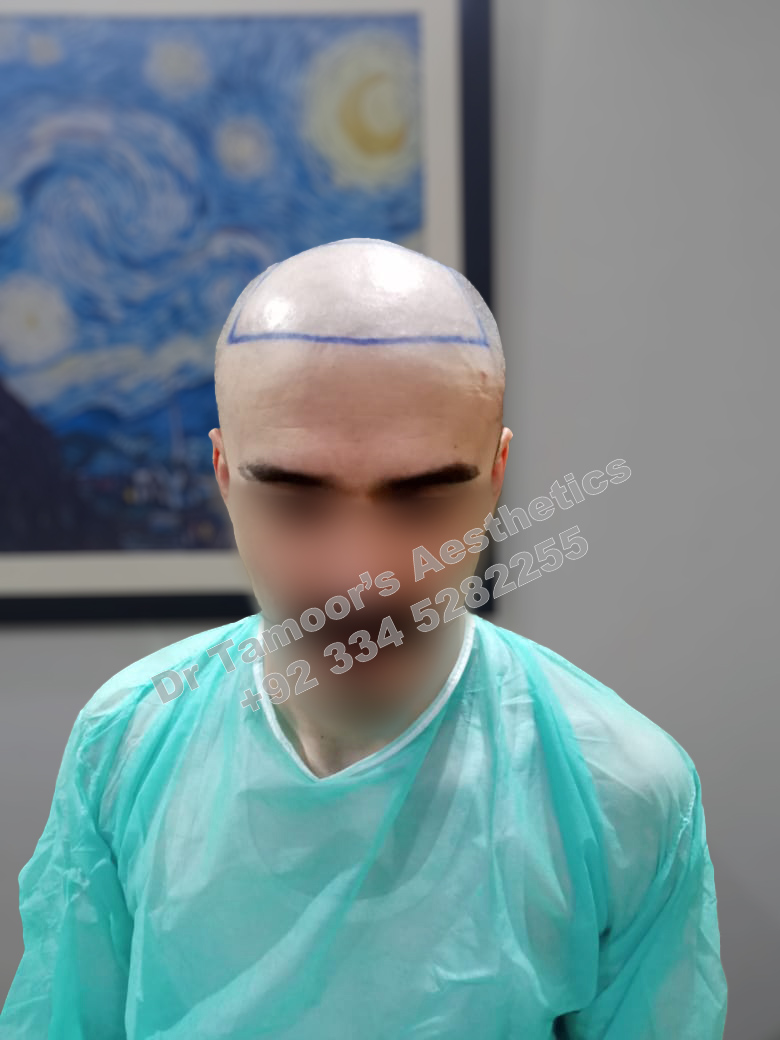 Before and after results of Hair Transplant procedure in Islamabad