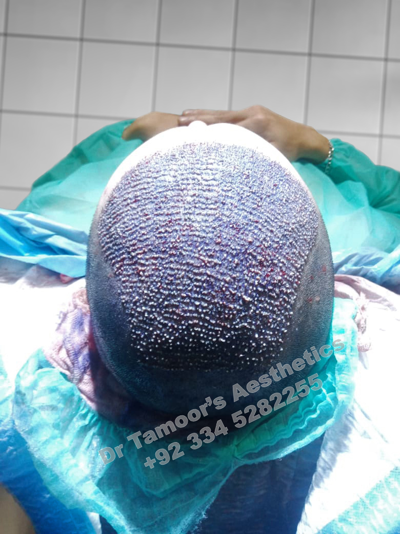 Before and after results of Hair Transplant procedure in Islamabad