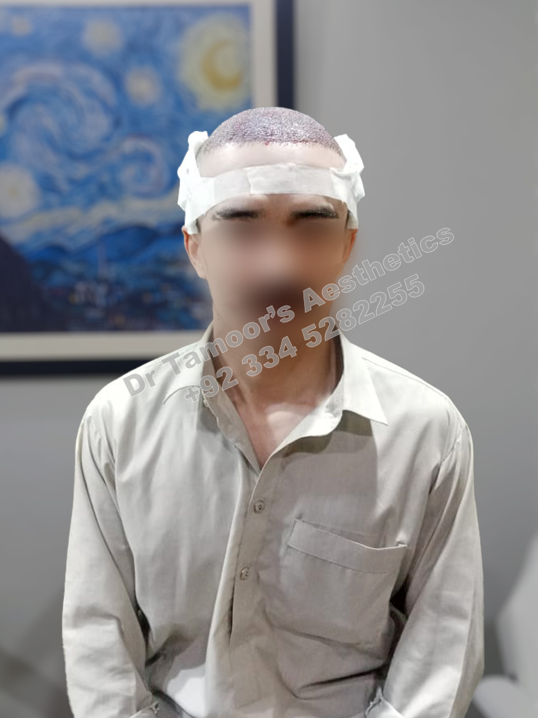Before and after results of Hair Transplant procedure in Islamabad