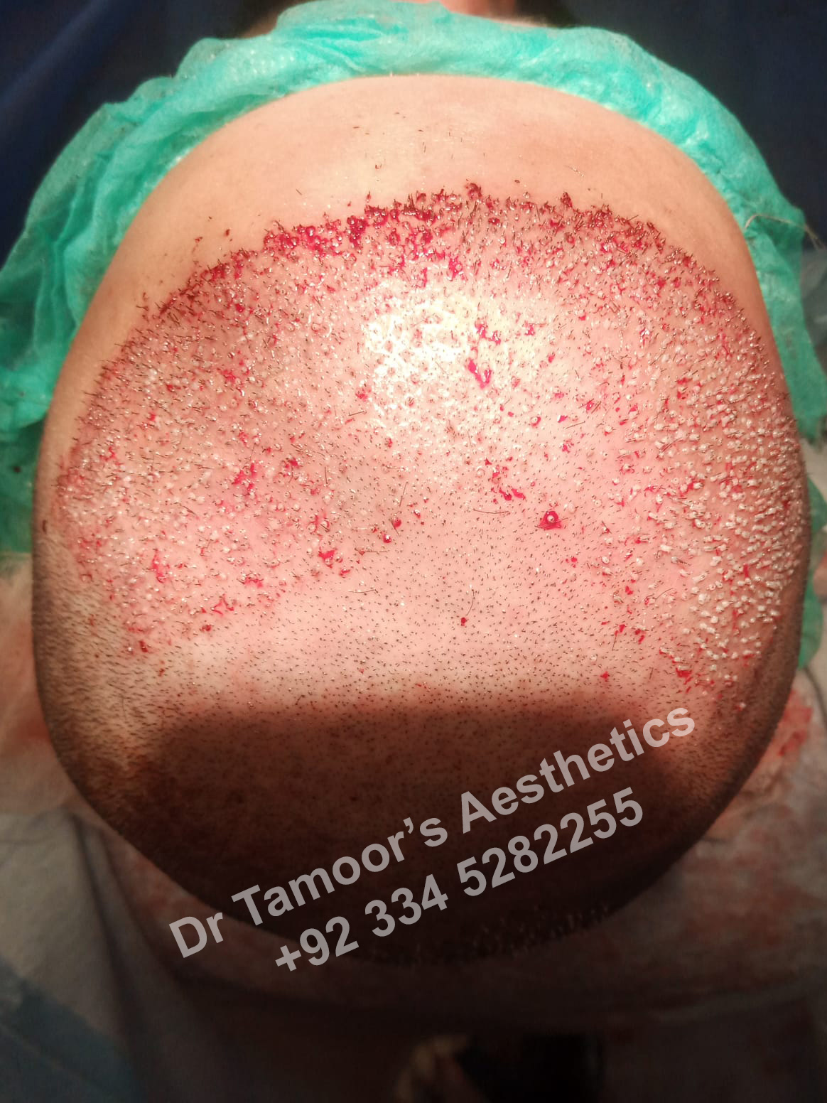 Before and after results of Hair Transplant procedure in Islamabad