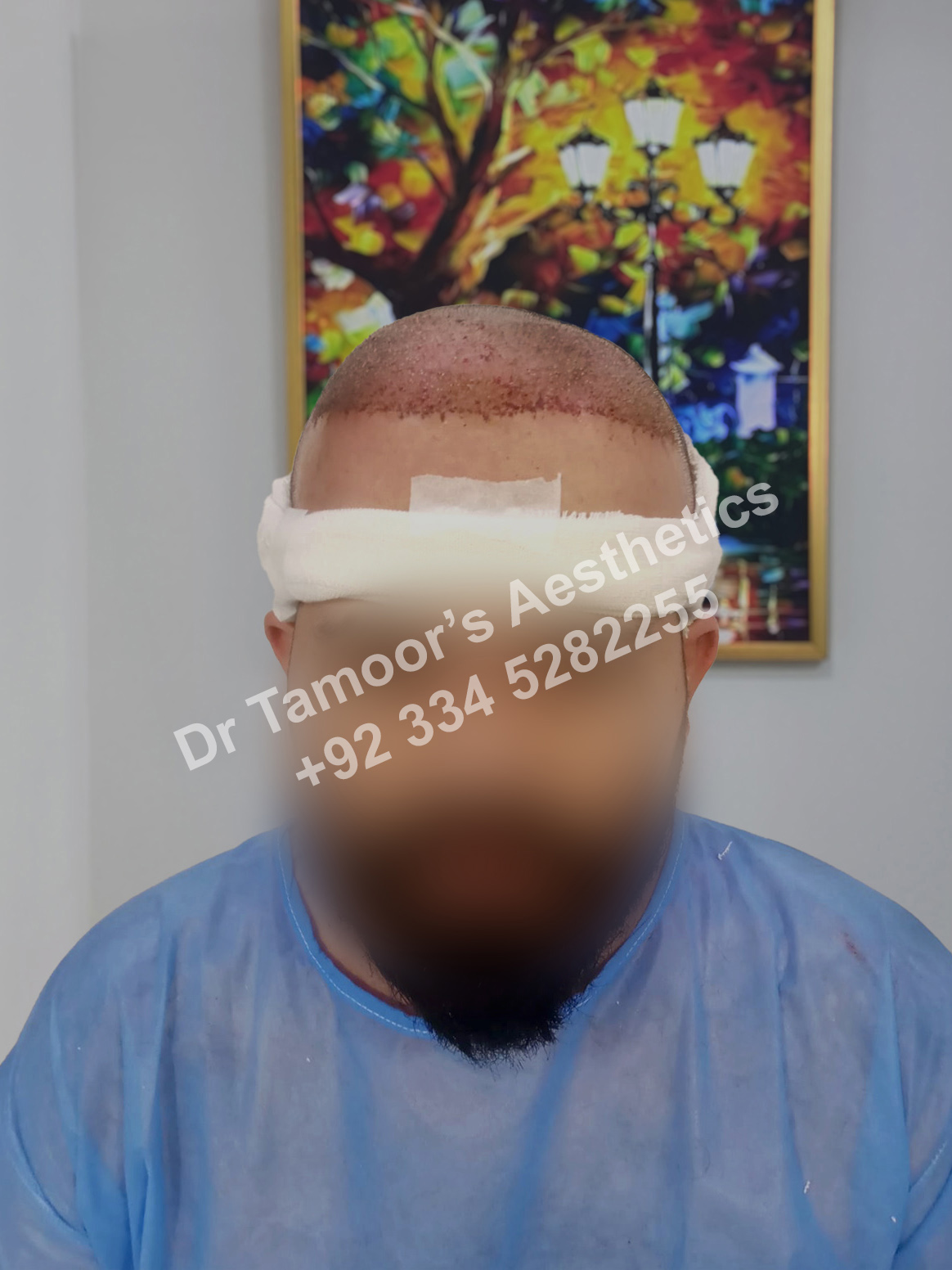 Before and after results of Hair Transplant procedure in Islamabad
