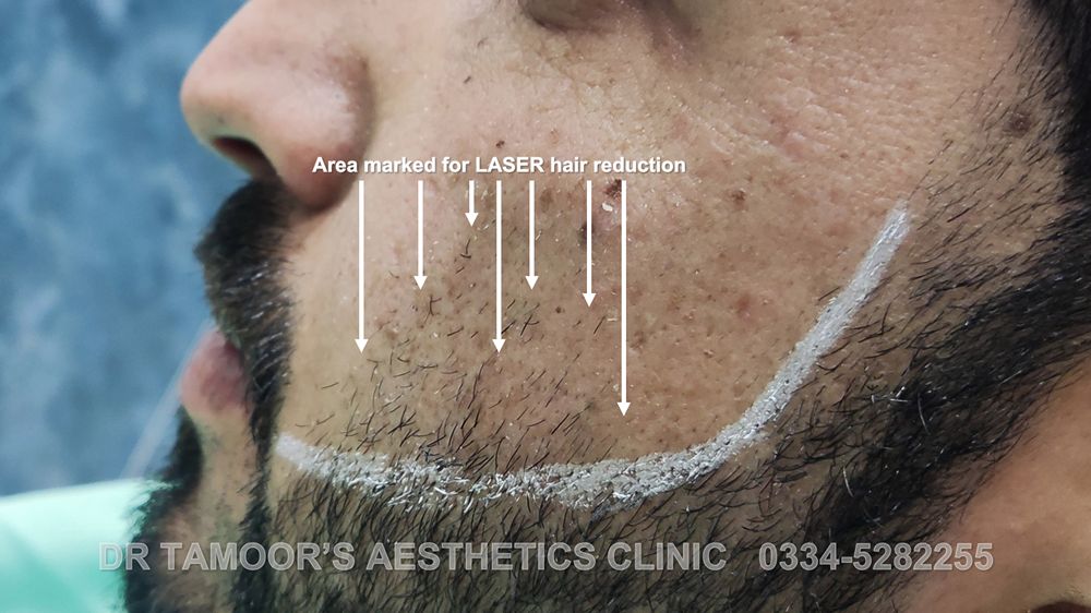 Laser beardline