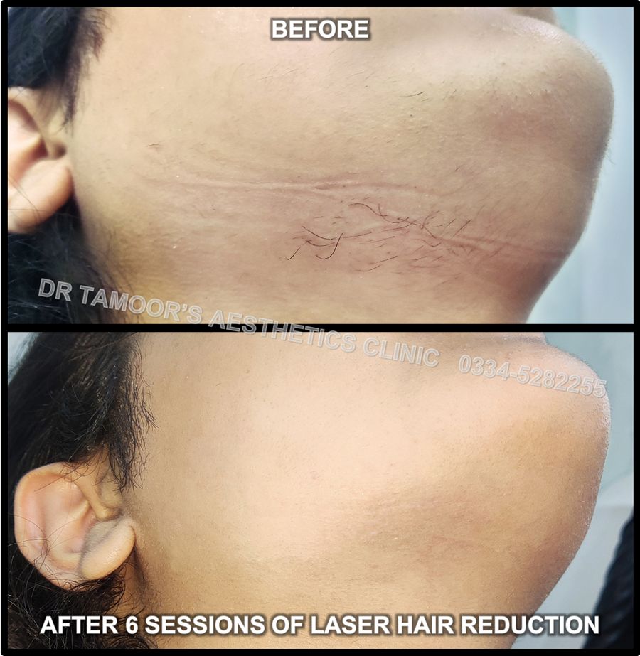 Laser hair removal
