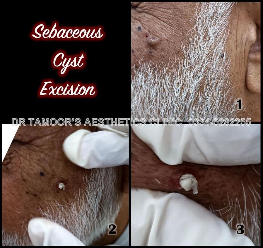 Mole Removal